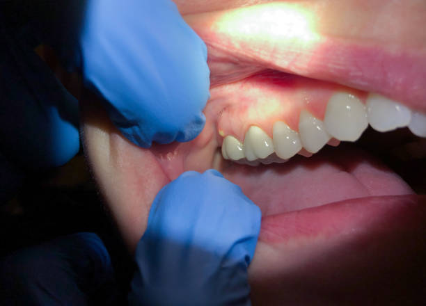 Urgent Tooth Repair in NC